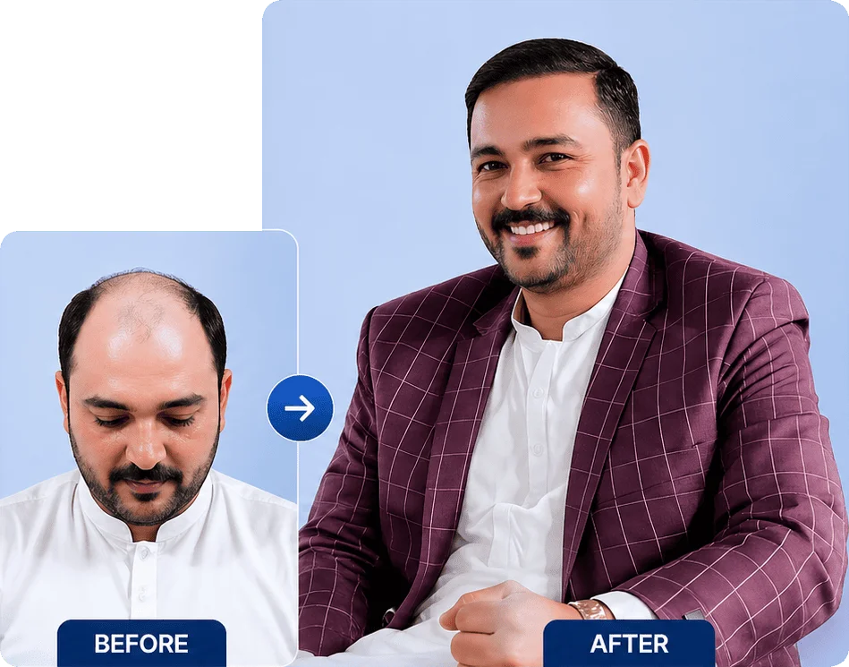 Hair Transplant Before and After Result