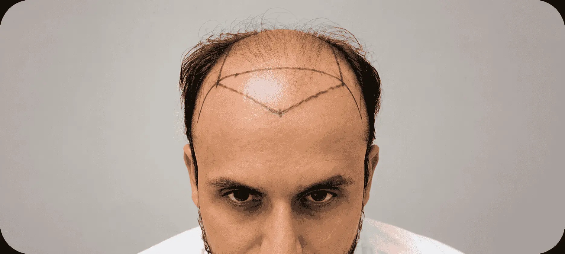 Hairline Design